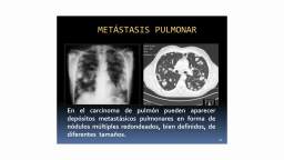 Signos del mediastino