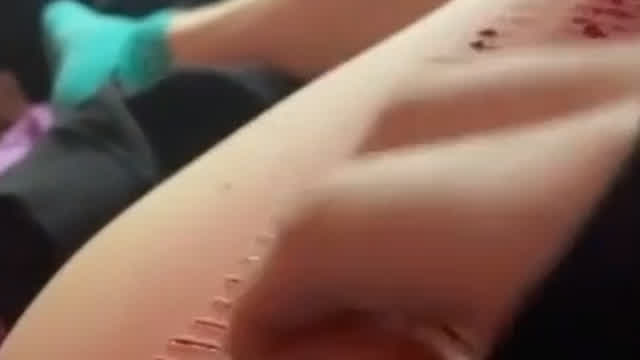 Cuts on Leg