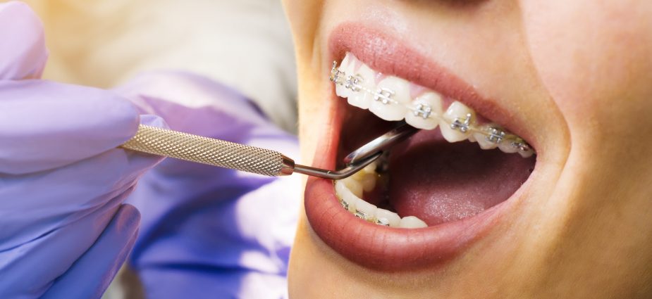 Staining and teeth discoloration